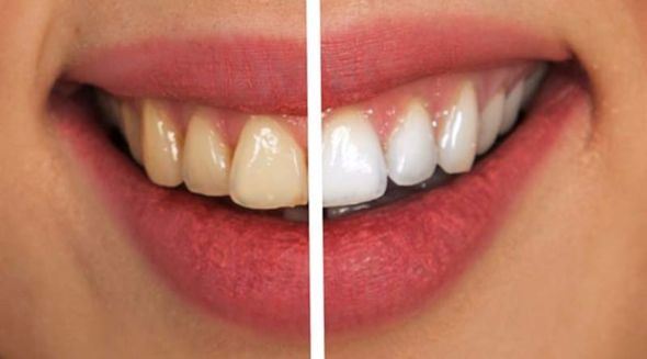 Sind Bleaching-Strips schädlich für die Zähne?