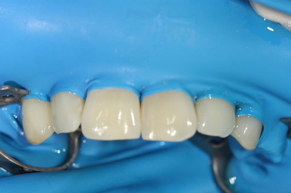 mikroinvasive Kariesinfiltration Schritt-4