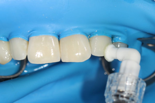 mikroinvasive Kariesinfiltration Schritt-3