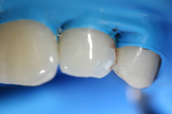 mikroinvasive Kariesinfiltration