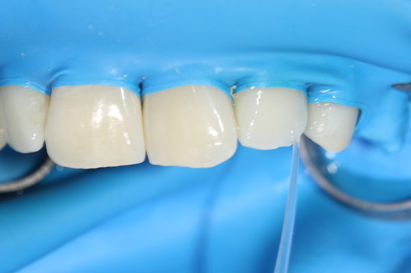 mikroinvasive Kariesinfiltration