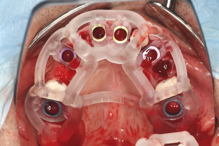Navigierte Implantation
