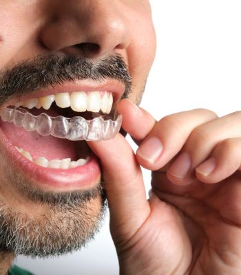 Retainer von SureSmile
