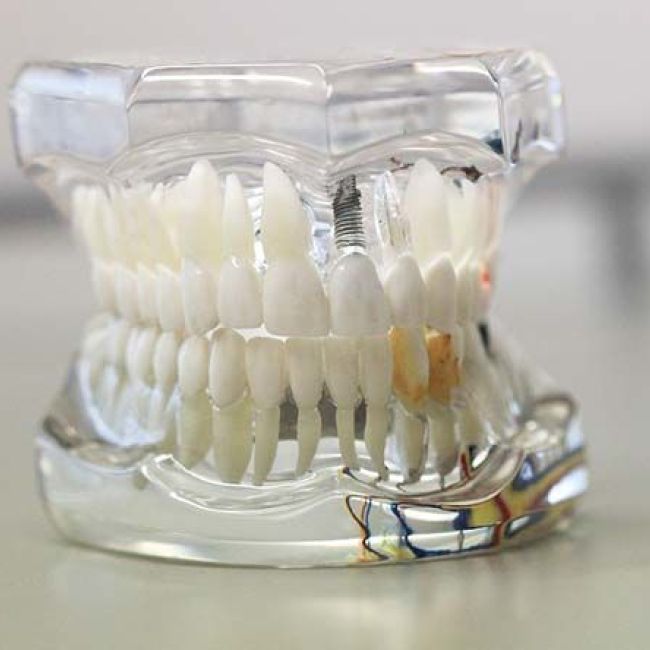 Knochenaufbau für Zahnimplantate