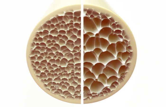 Bisphosphonate: Kann man implantieren?