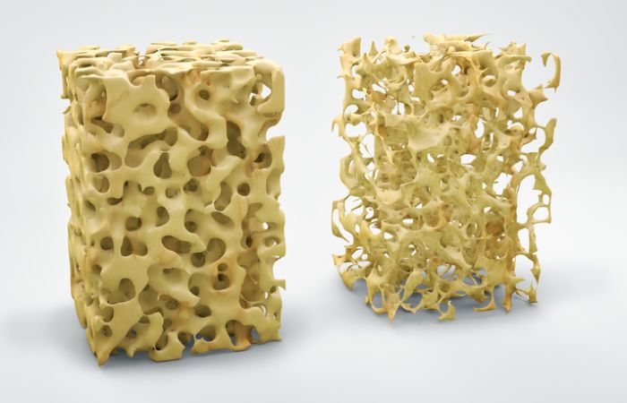 Implantate: Was tun bei Knochen-Stoffwechselstörung?