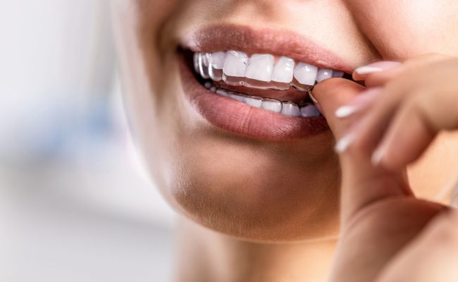 Unsichtbare Zahnspange – Zahnkorrektur mit Aligner in Berlin