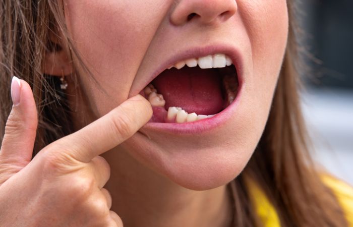 Jugendliche: Mobbing wegen Zahnverlust