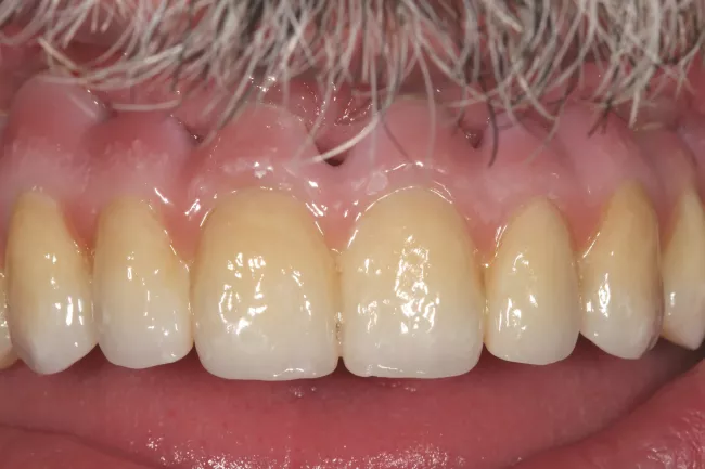 Klinische Ansicht der eingesetzten Implantatbrücke im Mund