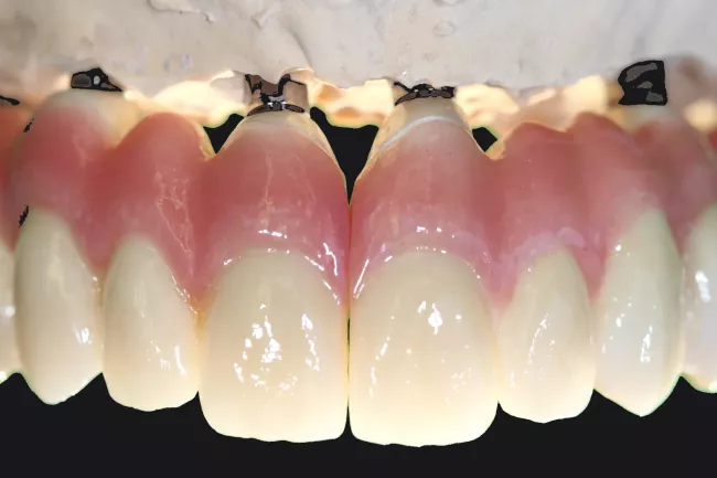 Rot-Weiss-Aesthetik nach Rekonstruktion bei grossem Knochendefizit